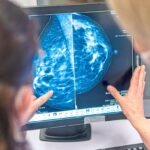 Perubahan gaya hidup dapat mengurangi risiko kanker payudara